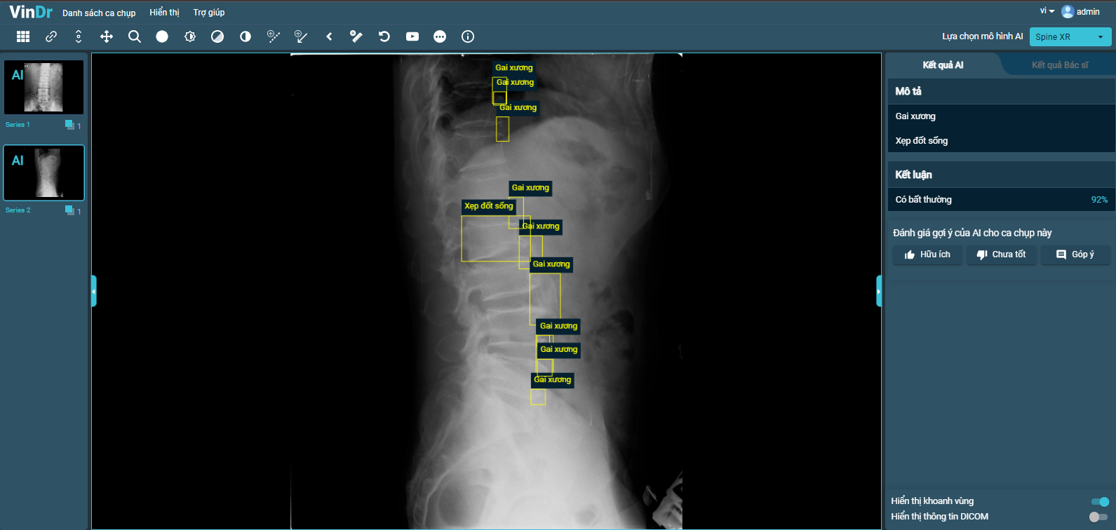 VinDr hoàn thiện tính năng mới SpineXR, hỗ trợ chẩn đoán ảnh X-quang cột sống với độ chính xác khoảng 90%.