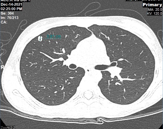 Hình chụp CT phối của cháu Khánh Thơ phát hiện khối u di căn phổi sau 1 năm phẫu thuật cắt bỏ u khớp gối