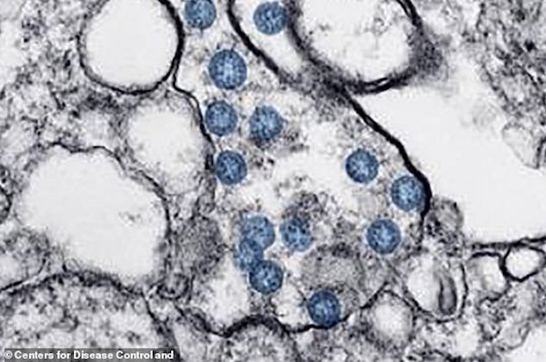 CDC công bố hình ảnh chi tiết cách thức virus Corona chủng mới xâm nhập cơ thể người bệnh