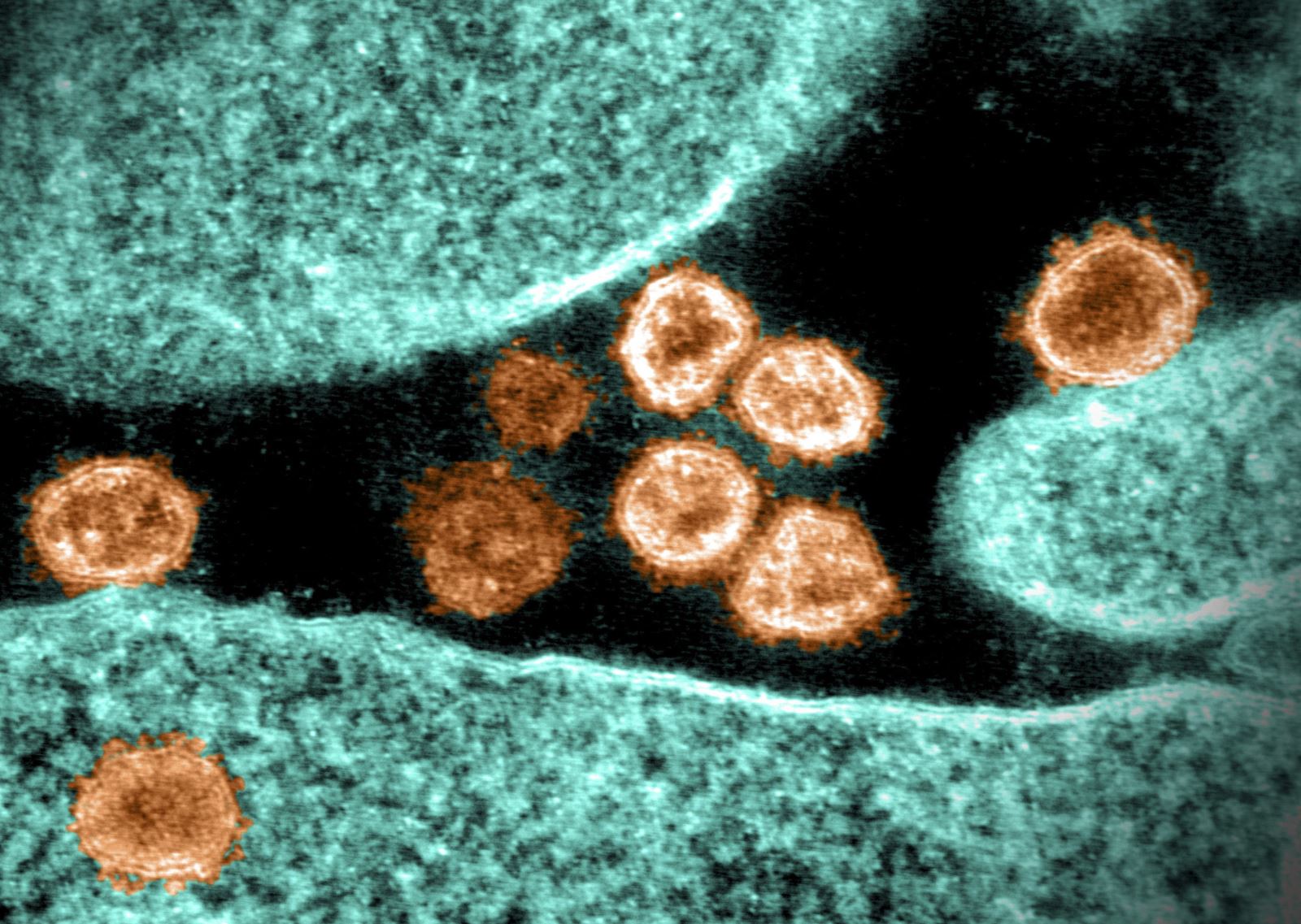 Hình ảnh từ kính hiển vi do Viện nghiên cứu bệnh truyền nhiễm và dị ứng quốc gia Mỹ cung cấp cho thấy virus SARS-CoV-2 trong mẫu bệnh phẩm của bệnh nhân mắc COVID-19 ở Mỹ