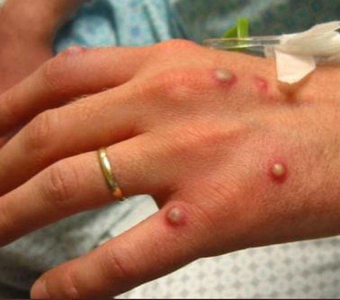 Bàn tay của một bệnh nhân nhiễm đậu mùa khỉ 