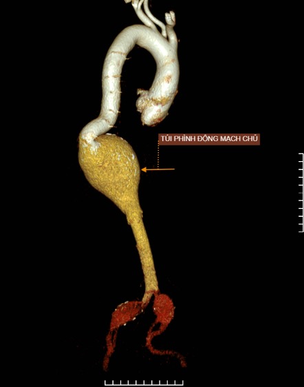 Hình ảnh túi phình hình thoi động mạch chủ ngực - bụng và động mạch chậu hai bên trên kết quả chụp CT