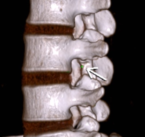 Hình ảnh lắng đọng tinh thể dạng urat vị trí lỗ tiếp hợp của cột sống thắt lưng 