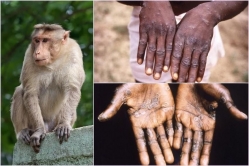 Bộ Y tế quy định bệnh nhân mắc đậu mùa khỉ cách ly tối thiểu 14 ngày